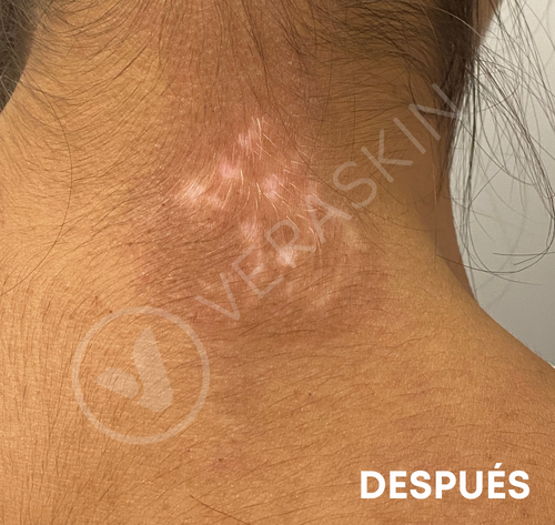 Ampollas Epidermicas Vitiligo