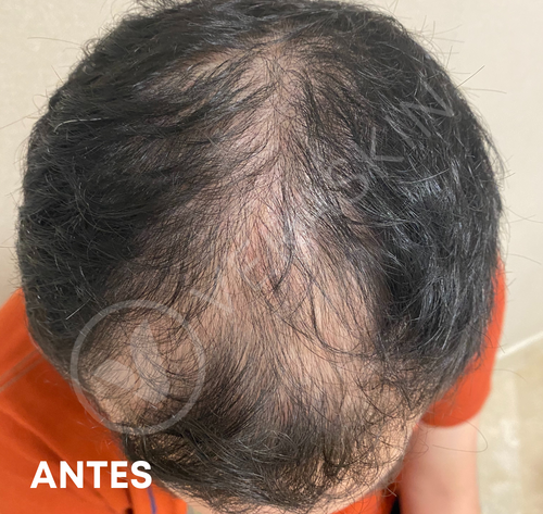 Alopecia Androgenetica