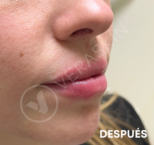 relleno labios