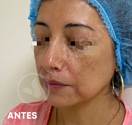 Armonizacion Facial