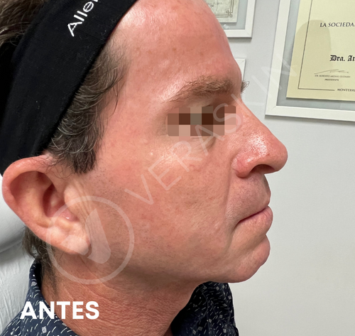 Armonizacion Facial