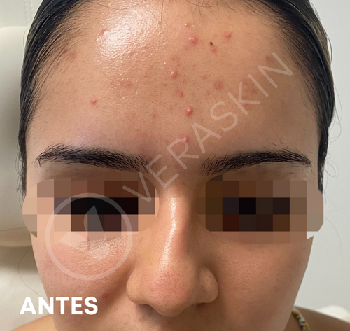 Acne tratamiento