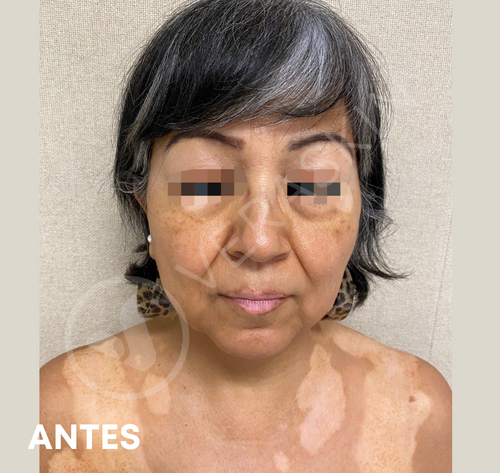 Tratamiento Médico Vitiligo