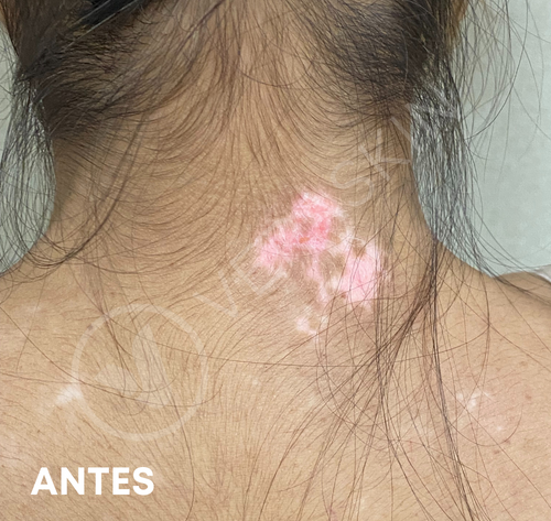 Vitiligo Ampollas Epidérmicas