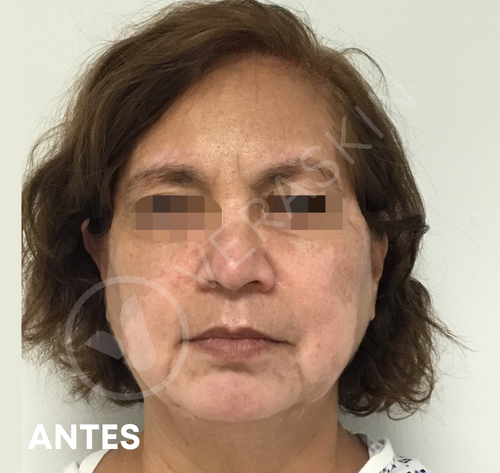 Tratamiento Médico Vitiligo