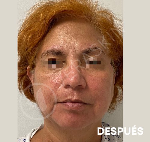 Tratamiento Médico Vitiligo